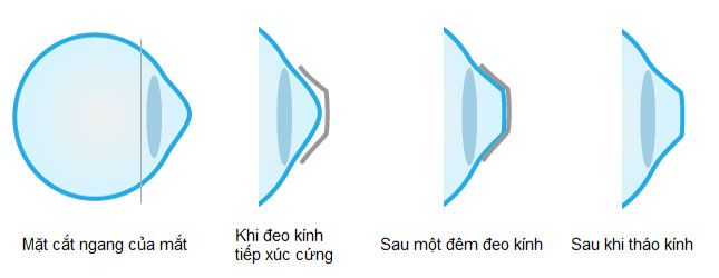 Công dụng của kính ortho k, Hỗ trợ thị lực bị tật khúc xạ, giúp cải thiện tầm nhìn, không phụ thuộc vào kính cận có gọng